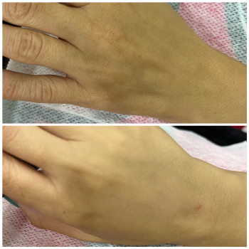 Фото до та після, одразу після процедури біоревіталізація.