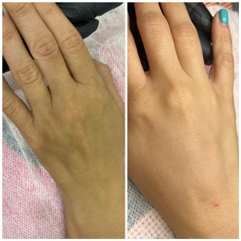 Техніка канюльна - через 1 прокол