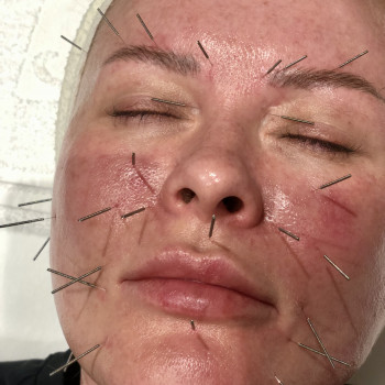 Face Lifting Acupuncture (голки)
                    Масажист Николай Київ