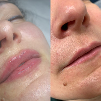 Збільшення губ