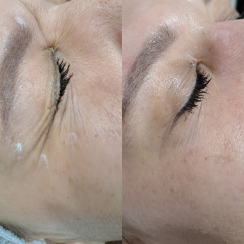 Ботокс зони навколо очей 
Ефект-4-6 міс