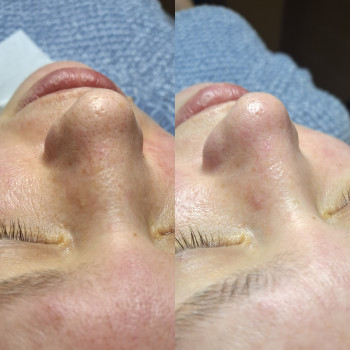 Чистка обличчя