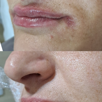 Підняття кутиків губ + легка корекція губ