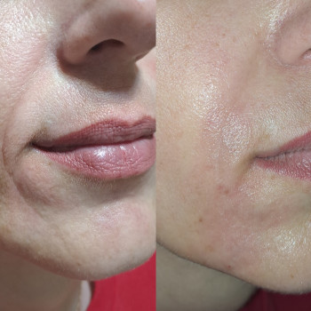 Заповнення носогубних складок філером + бланшингтерапія