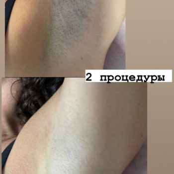 Пахви після 2-х процедур