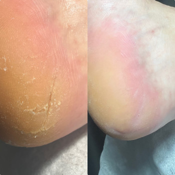 Тріщини на пятах