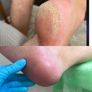 Тріщини на пятах