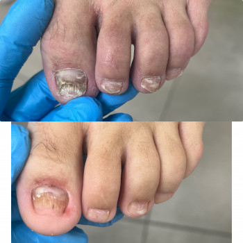 Оніхомікоз нігтів