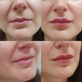 Рефрешинг губ
                    Лікар-косметолог Оксана Київ