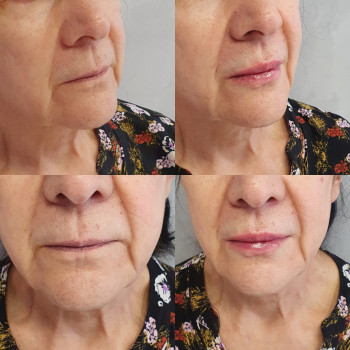 Рефрешинг губ
                    Лікар-косметолог Оксана Київ