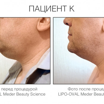 Липо-Овал —  Программа похудения лица, уменьшения отечности и второго подбородка
                    Мастер по пирсингу Татьяна Киев