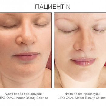 Липо-Овал —  Программа похудения лица, уменьшения отечности и второго подбородка
                    Мастер по пирсингу Татьяна Киев