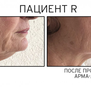 Программа “Arma-Lift”— результат