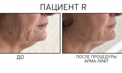 Arma-Lift — Программа Неинвазивного лифтинга и подтяжки лица Мастер по пирсингу Татьяна Киев