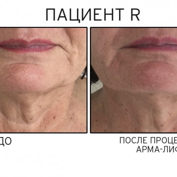 Arma-Lift — Программа Неинвазивного лифтинга и подтяжки лица
                    Мастер по пирсингу Татьяна Киев