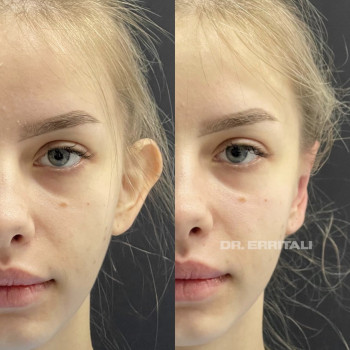 Отопластика (пластика ушей)
                    Пластический хирург Абдель Харьков