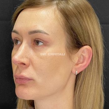 Блефаропластика круговая (верхних и нижних век)
                    Пластический хирург Абдель Харьков