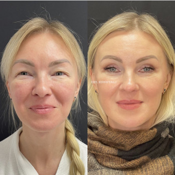 Блефаропластика круговая (верхних и нижних век)
                    Пластический хирург Абдель Харьков