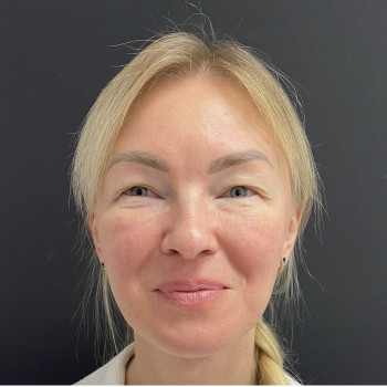 Блефаропластика круговая (верхних и нижних век)
                    Пластический хирург Абдель Харьков