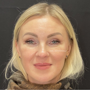 Блефаропластика круговая (верхних и нижних век)
                    Пластический хирург Абдель Харьков