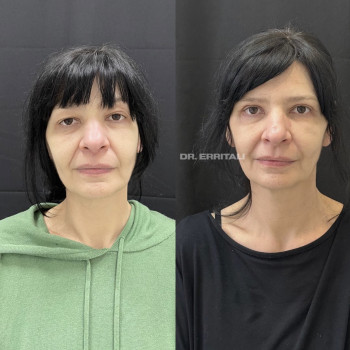 Блефаропластика круговая (верхних и нижних век)
                    Пластический хирург Абдель Харьков