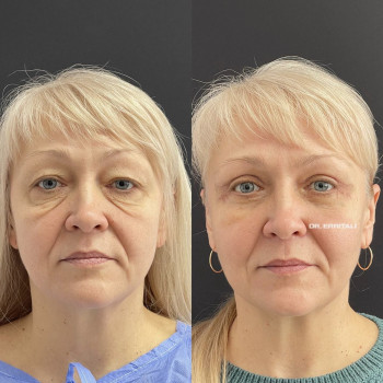 Блефаропластика круговая (верхних и нижних век)
                    Пластический хирург Абдель Харьков