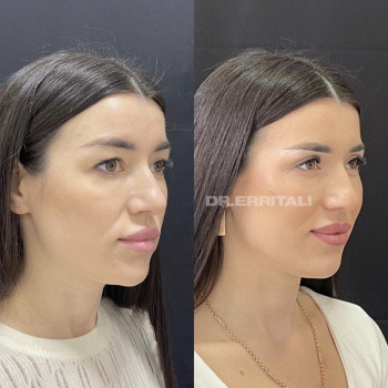 Лазерная блефаропластика
                    Пластический хирург Абдель Харьков