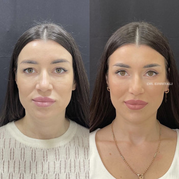 Лазерная блефаропластика
                    Пластический хирург Абдель Харьков