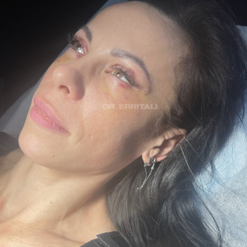 Лазерная блефаропластика
                    Пластический хирург Абдель Харьков