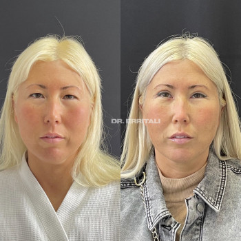 Лазерная блефаропластика
                    Пластический хирург Абдель Харьков