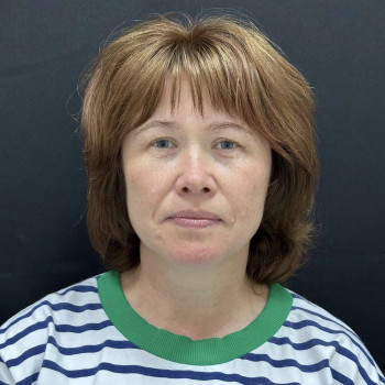 Лазерная блефаропластика
                    Пластический хирург Абдель Харьков