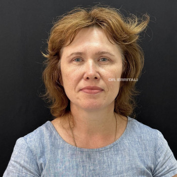 Лазерная блефаропластика
                    Пластический хирург Абдель Харьков