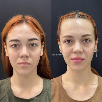 Лазерная блефаропластика
                    Пластический хирург Абдель Харьков