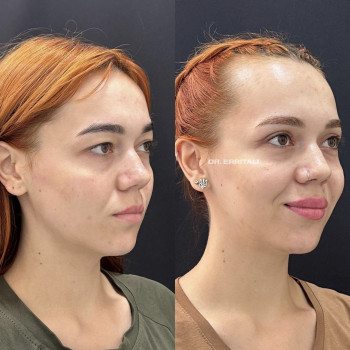 Лазерная блефаропластика
                    Пластический хирург Абдель Харьков