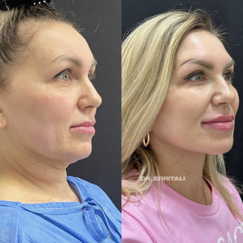 Лазерная блефаропластика
                    Пластический хирург Абдель Харьков