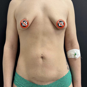 Абдоминопластика (пластика живота)
                    Пластический хирург Абдель Харьков