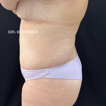 Абдоминопластика (пластика живота)
                    Пластический хирург Абдель Харьков