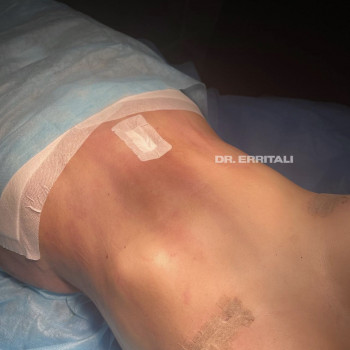 Абдоминопластика (пластика живота)
                    Пластический хирург Абдель Харьков