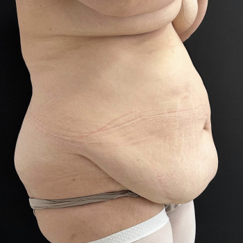 Абдоминопластика (пластика живота)
                    Пластический хирург Абдель Харьков