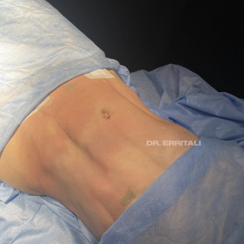 Абдоминопластика (пластика живота)
                    Пластический хирург Абдель Харьков