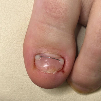 Титановая нить, фото - подолог Татьяна Вакула