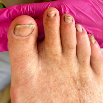 Фото из портфолио специалиста Татьяна Вакула (подолог, Харьков)