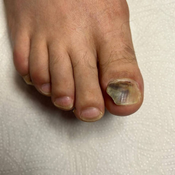 Фото из портфолио специалиста Татьяна Вакула (подолог, Харьков)