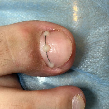 Титановая нить, фото - подолог Татьяна Вакула