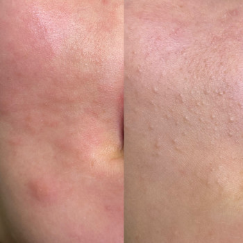 Комбінована чистка обличчя
                    Косметолог Людмила Киев