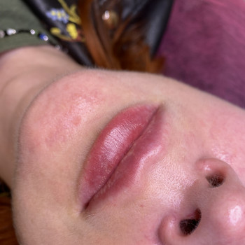 Контурна пластика губ
                    Косметолог Людмила Киев