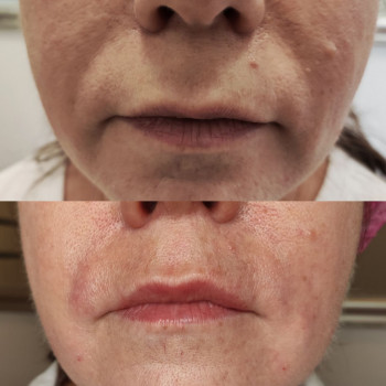 Заповнення носогубних зморшок
                    Косметолог Людмила Киев