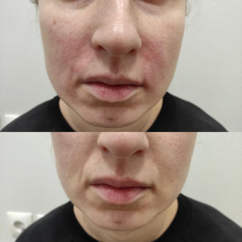 Заповнення носогубних зморшок
                    Косметолог Людмила Киев