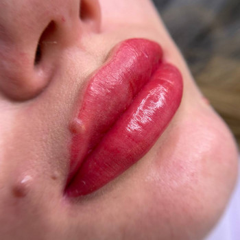 4. Після процедури