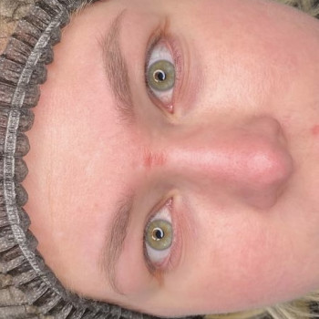 2. Міжвійка До процедури